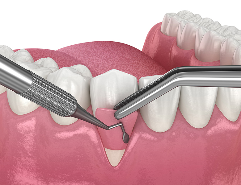 西馬込（大田区）の歯医者、なおい歯科クリニックのマイクロスコープ精密治療