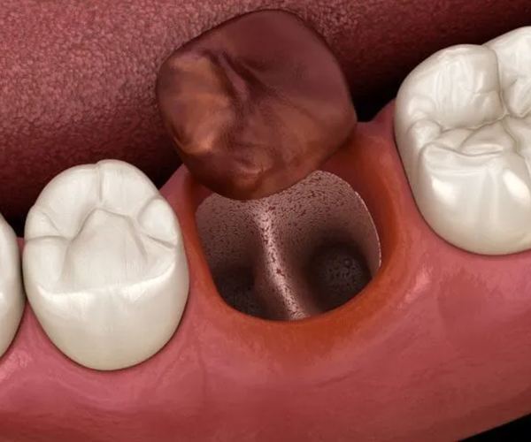 西馬込（大田区）の歯医者、なおい歯科クリニックの親知らずの抜歯