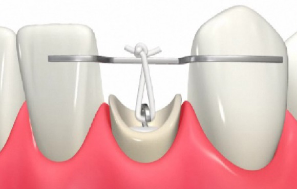 西馬込（大田区）の歯医者、なおい歯科クリニックのむし歯治療