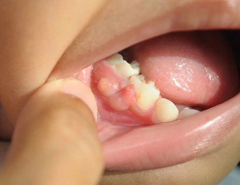 西馬込（大田区）の歯医者、なおい歯科クリニックのお口の中のデキモノ