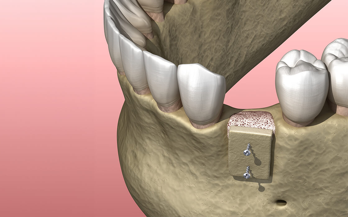 西馬込（大田区）の歯医者、なおい歯科クリニックのインプラント治療