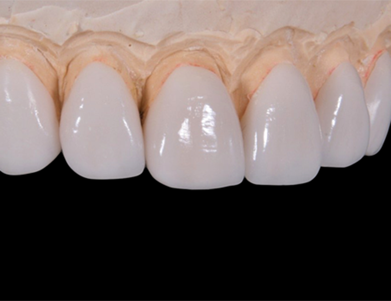 西馬込（大田区）の歯医者、なおい歯科クリニックの審美歯科治療