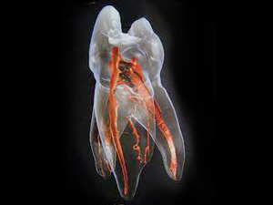 西馬込（大田区）の歯医者、なおい歯科クリニックの根管治療