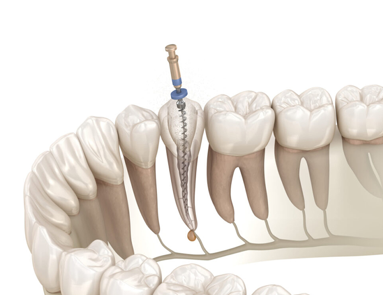 西馬込（大田区）の歯医者、なおい歯科クリニックのマイクロスコープ精密治療