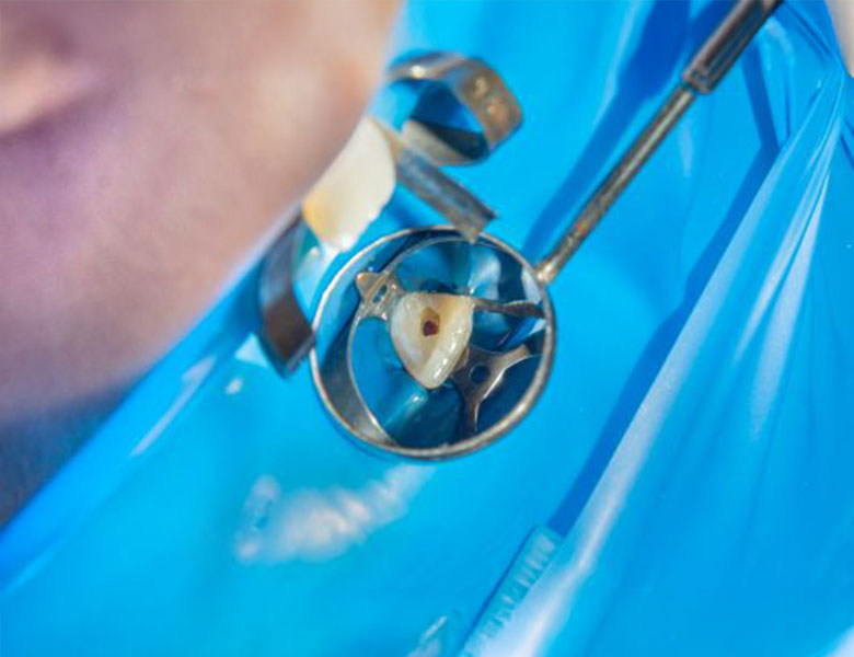 西馬込（大田区）の歯医者、なおい歯科クリニックのマイクロスコープ精密治療