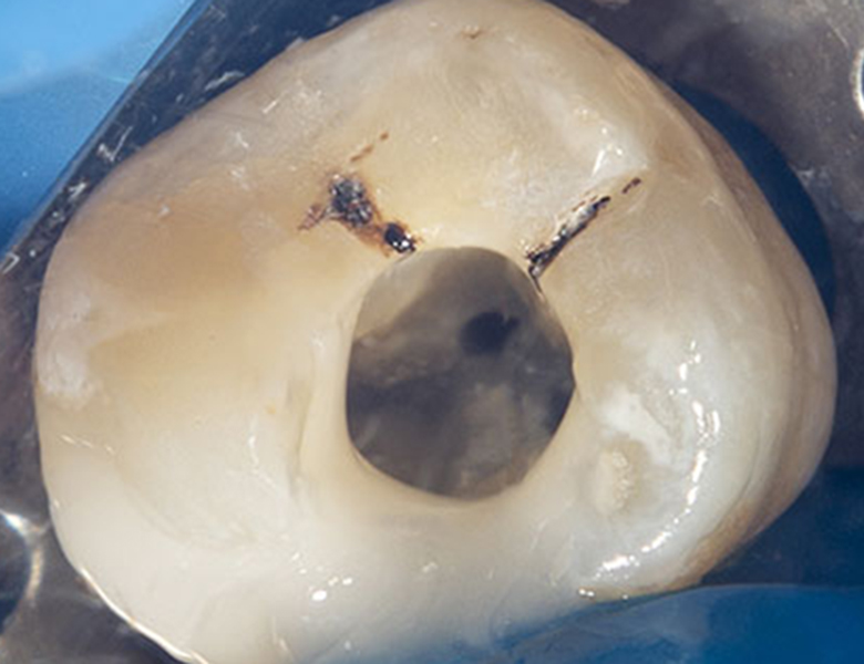 西馬込（大田区）の歯医者、なおい歯科クリニックのマイクロスコープ精密治療