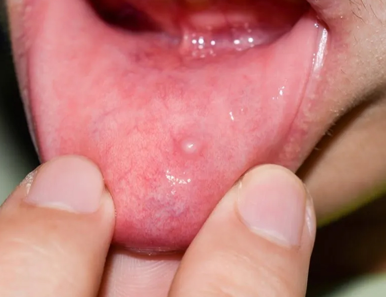 西馬込（大田区）の歯医者、なおい歯科クリニックのお口の中のデキモノ