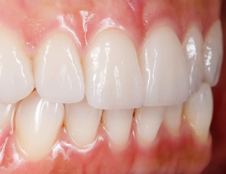 西馬込（大田区）の歯医者、なおい歯科クリニックの審美歯科治療